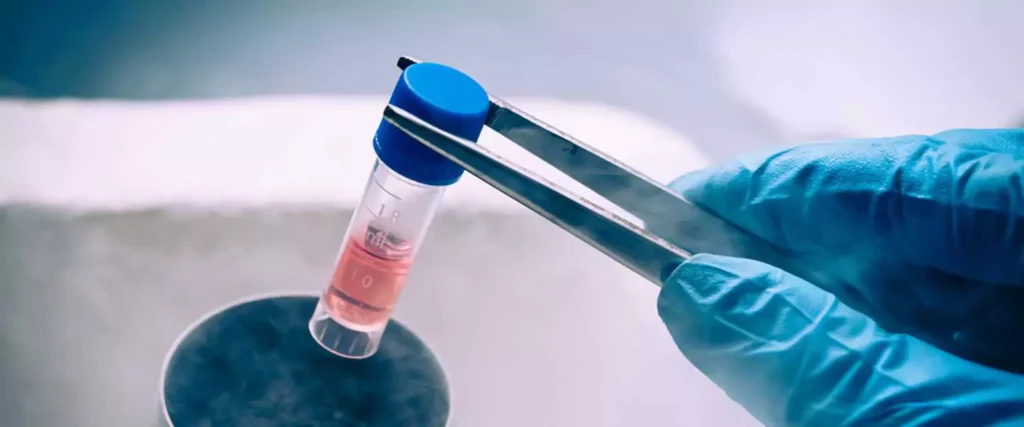 Échantillon de cellules SVF dans un tube de laboratoire, utilisé dans le cadre de la thérapie par cellules souches SVF en Turquie.