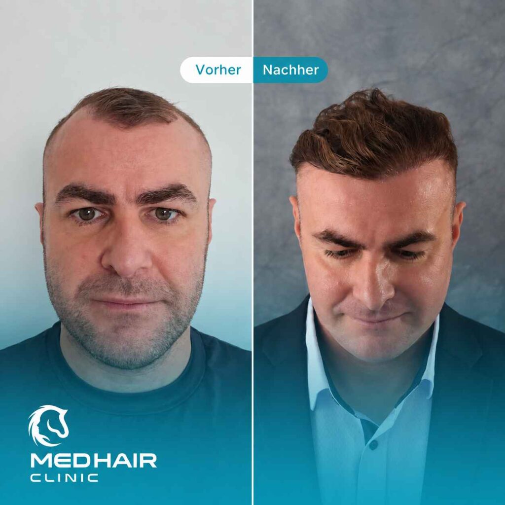 Haartransplantation Ergebnis nach 7 Monate