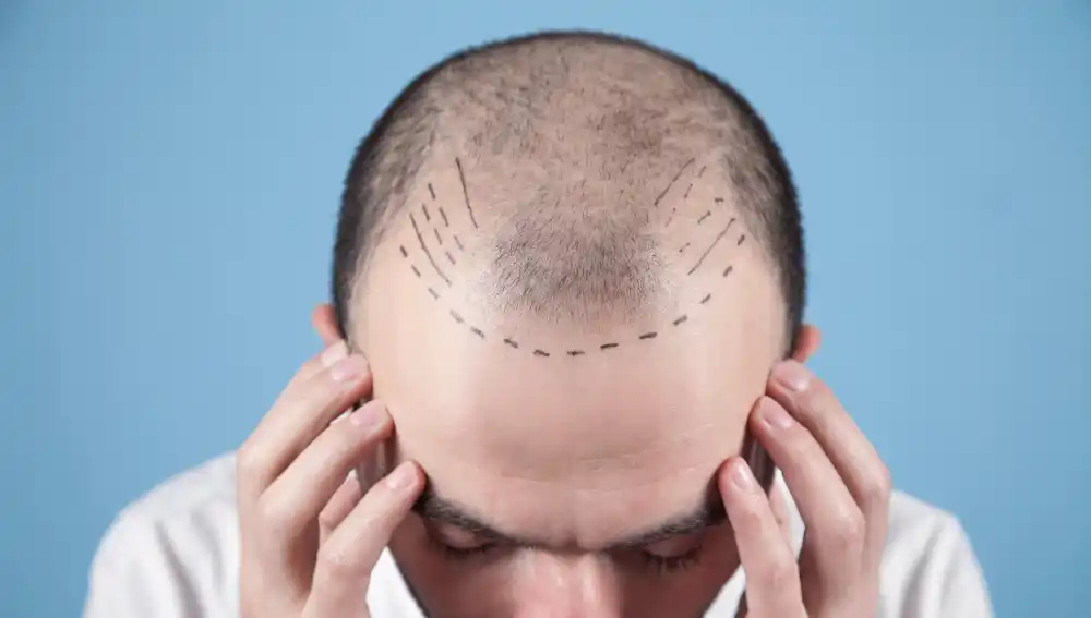 Homme au cuir chevelu clairsemé avec une ligne frontale et des zones d’implantation dessinées avant une greffe capillaire.