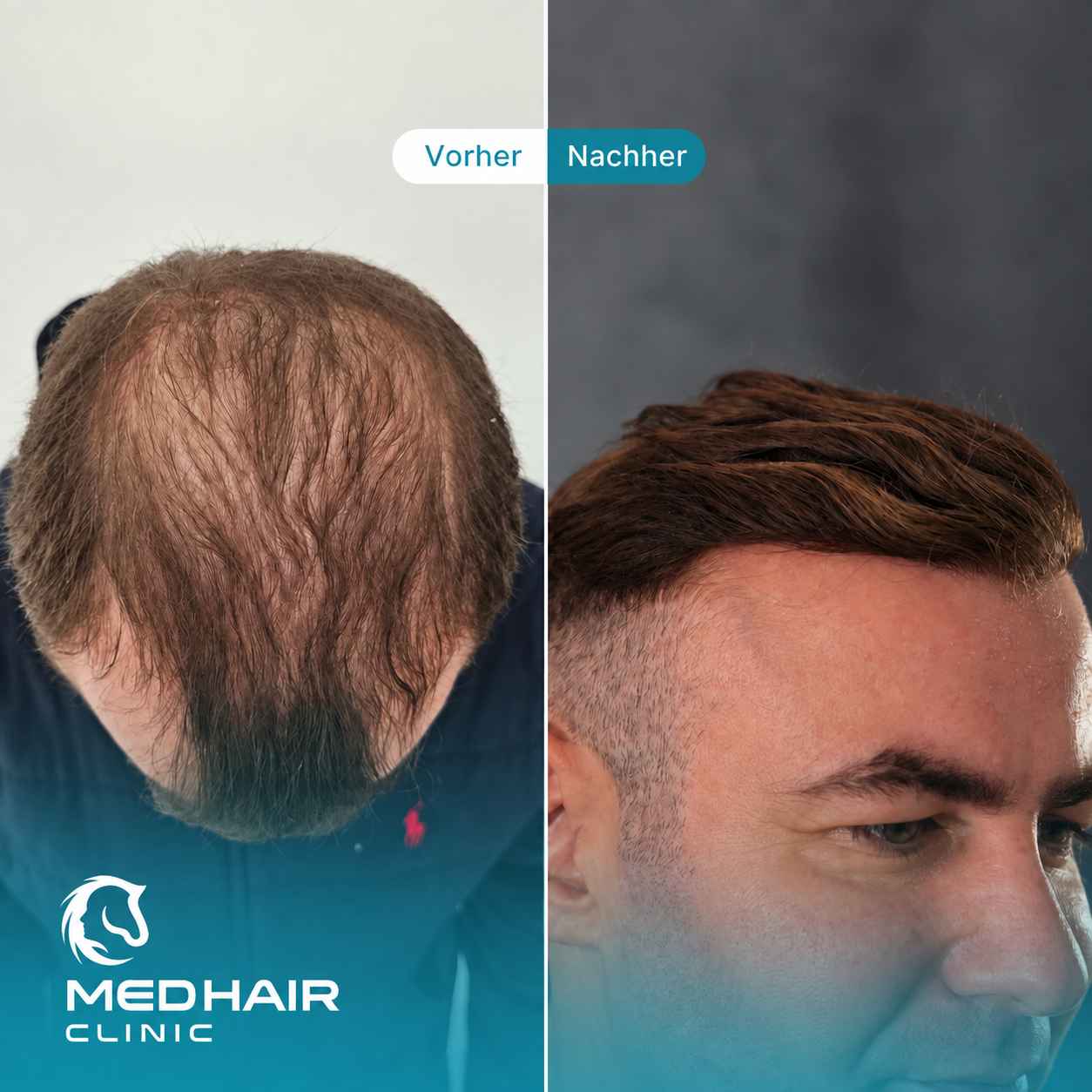 Haartransplantation mit 4500 Grafts