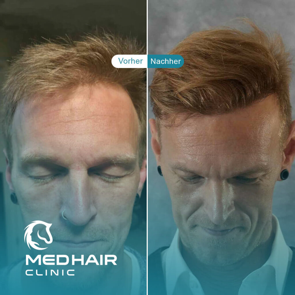 Haartransplantation Vorher Nachher – Ergebnis mit 3700 Grafts