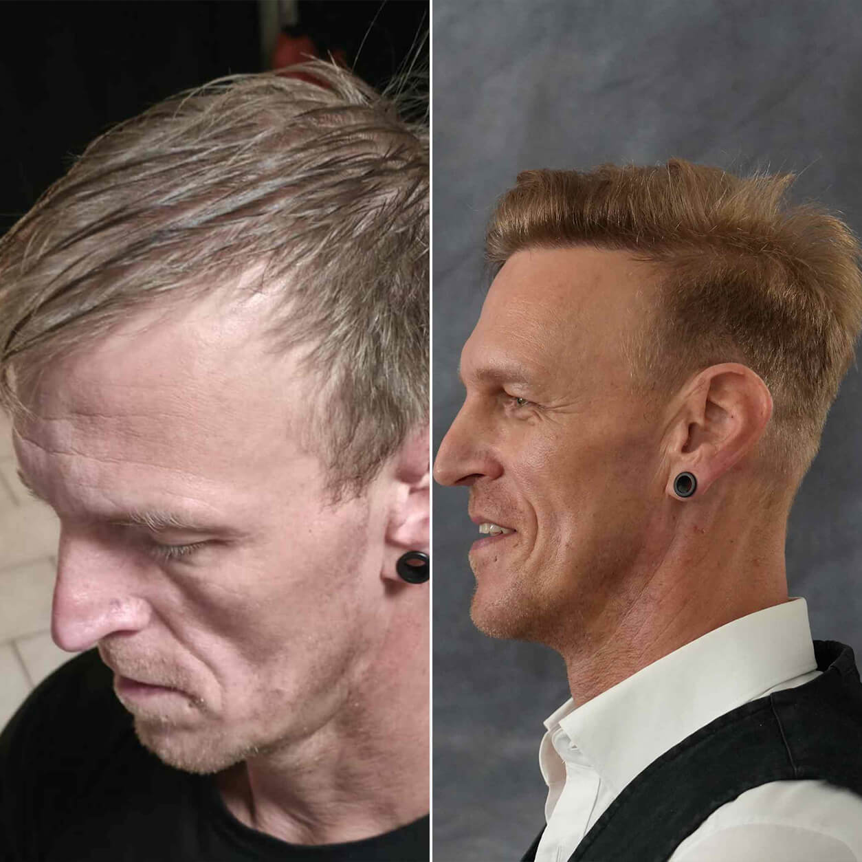 3700 Grafts Haartransplantation – Vorher Nachher Vergleich der linken Seite