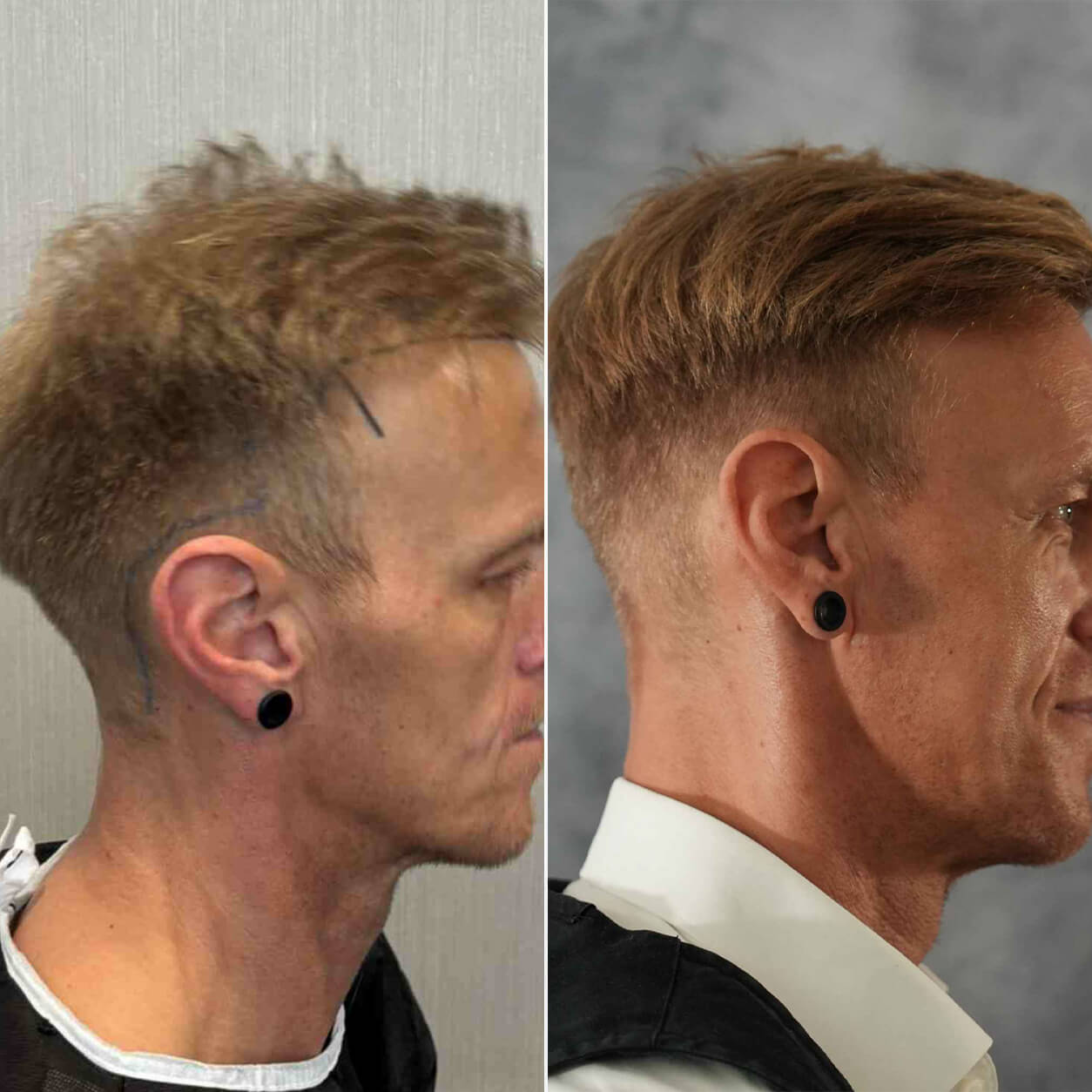 Haartransplantation mit 3700 Grafts – Vorher Nachher Ergebnis auf der rechten Seite