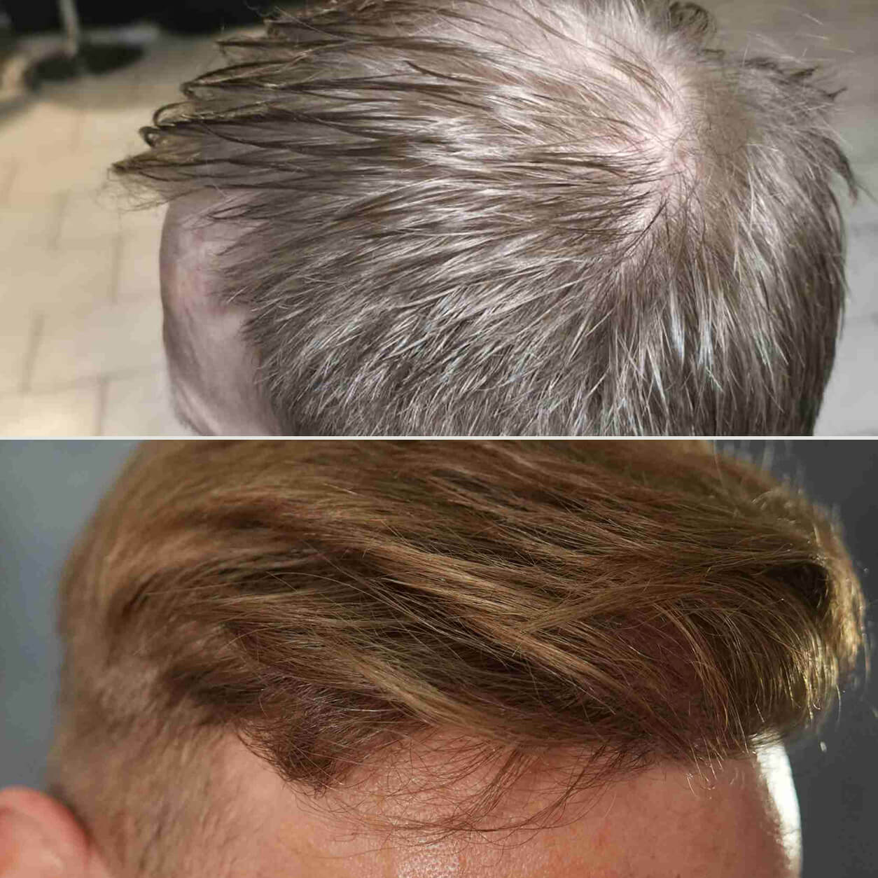 3700 Grafts Haartransplantation Vorher Nachher – Ergebnis an der Tonsur