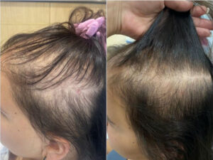 Haaransatz und Schläfen Vorher Nachher – Natürliches Ergebnis der Haartransplantation