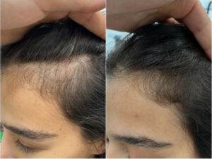 Haartransplantation Vorher Nachher – Haaransatz und Schläfen im Vergleich