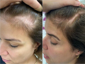 Haaransatz und Schläfen – Vorher Nachher nach der Haartransplantation