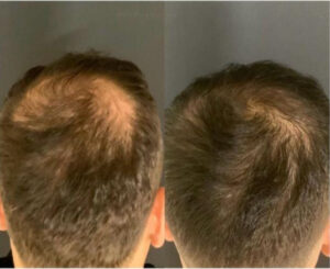 Hinterkopf und Haarwirbel Vorher Nachher – Ergebnis nach der Haartransplantation