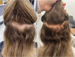 Hinterkopf und Scheitel Vorher Nachher – Ergebnis nach der Haartransplantation