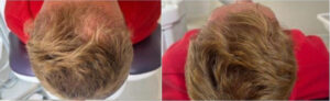 Oberkopf und Haarwirbel in der Ansicht – Vorher Nachher nach der Haartransplantation