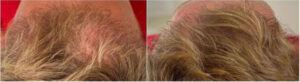 Oberkopf und Haarwirbel im Detail – Vorher Nachher Ergebnis der Haartransplantation