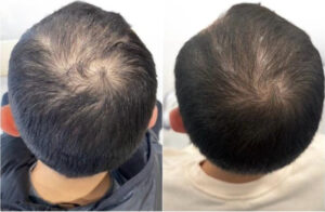 Oberkopf und Haarwirbel Vorher Nachher – Ergebnis nach der Haartransplantation