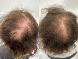 Oberkopf und Scheitel Vorher Nachher – Ergebnis nach der Haartransplantation