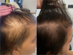 Schläfen und Seitenscheitel Vorher Nachher – Natürliches Ergebnis der Haartransplantation