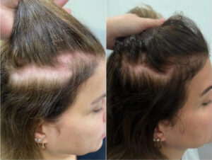 Schläfen und seitlicher Scheitel Vorher Nachher – Ergebnis nach der Haartransplantation