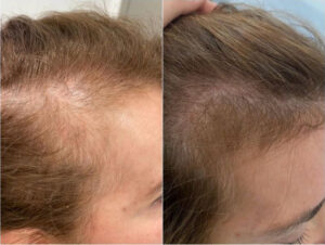 Seitlicher Haaransatz Vorher Nachher – Natürliches Ergebnis nach der Haartransplantation