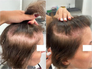 Oberkopf und Schläfen Vorher Nachher – Ergebnis nach der Haartransplantation