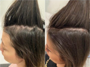 Seitlicher Scheitel Vorher Nachher – Ergebnis nach der Haartransplantation