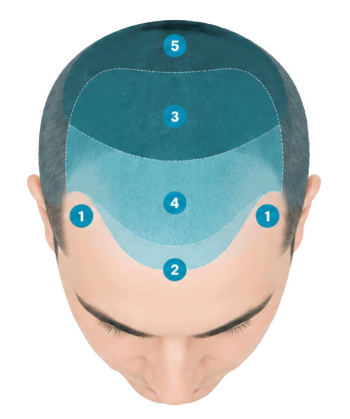 Estimated hair transplant graft counts for different areas and stages of hair loss.